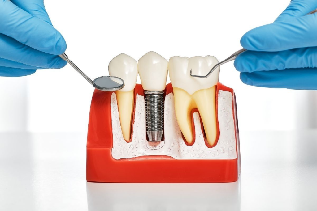 Implants in Agoura Hills