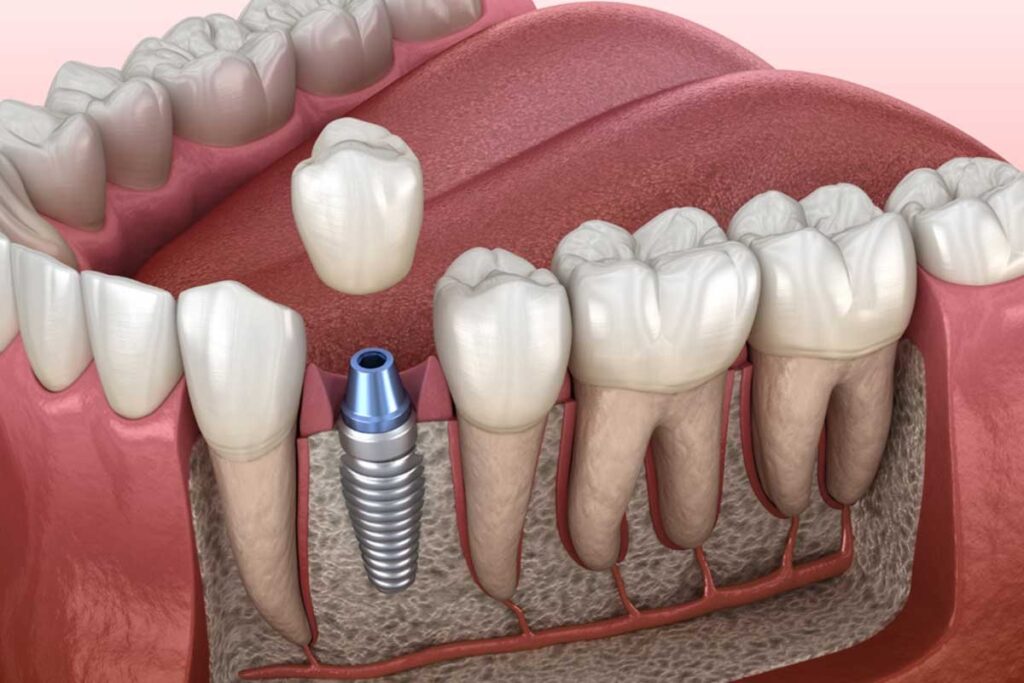 Same day implants in Agoura Hills